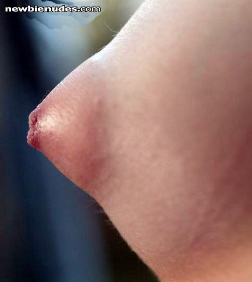 GILLIANS ENLARGED NIPPLE
