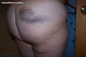 My Bruised bum...ouch!