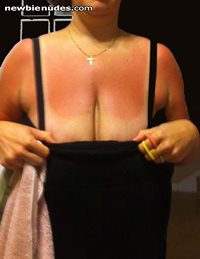 Wife's sun burn.