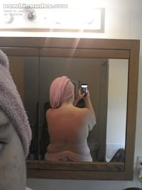 My burnt back after laying in the sun...