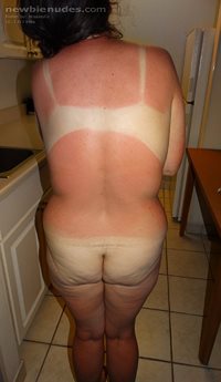 There wasn't a category for sun burnt.